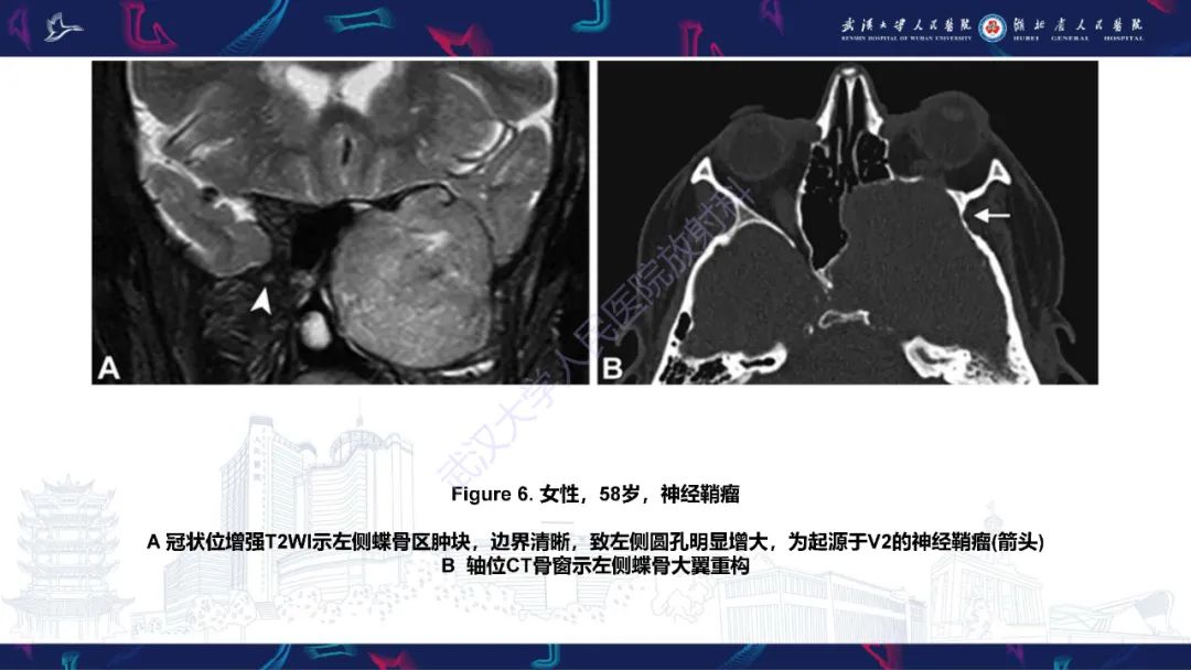 影像PPT - 【PPT】蝶骨大翼病变影像诊断-17