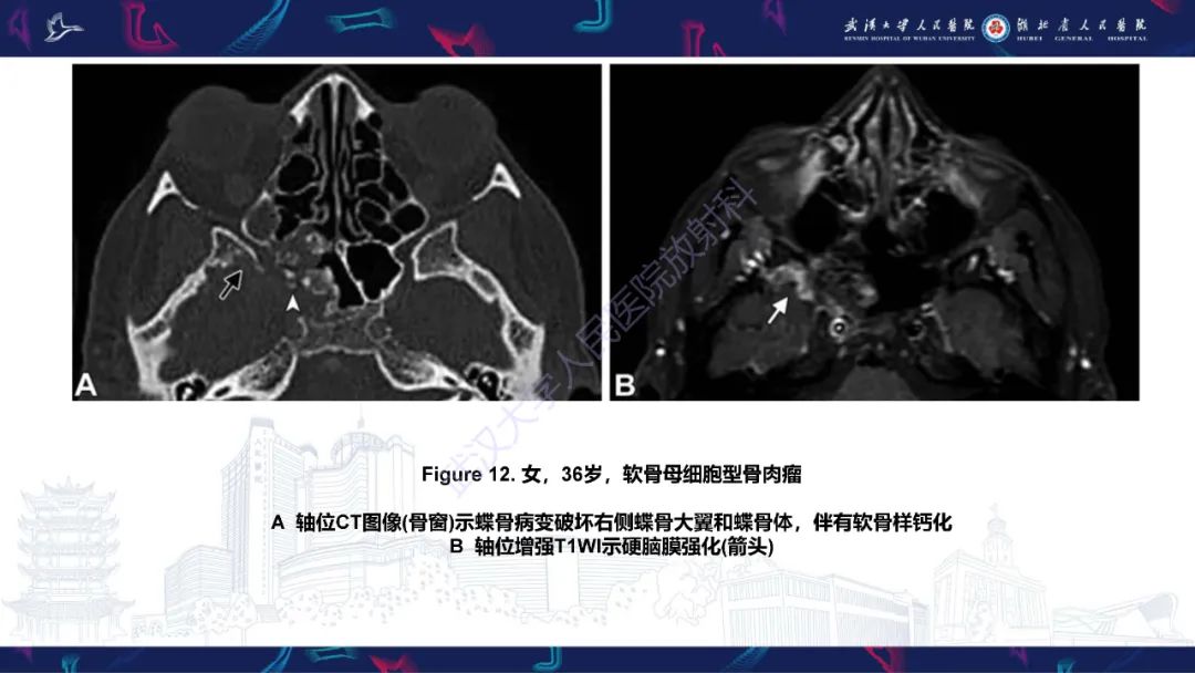 影像PPT - 【PPT】蝶骨大翼病变影像诊断-26