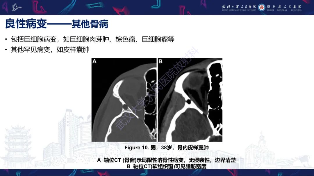 影像PPT - 【PPT】蝶骨大翼病变影像诊断-22