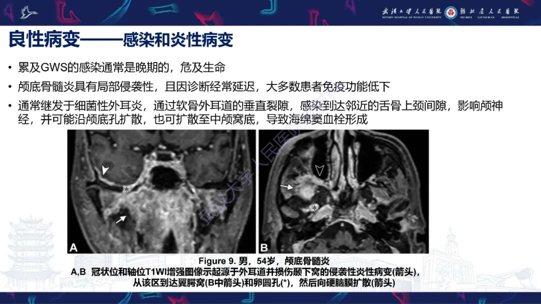 影像PPT - 【PPT】蝶骨大翼病变影像诊断-21