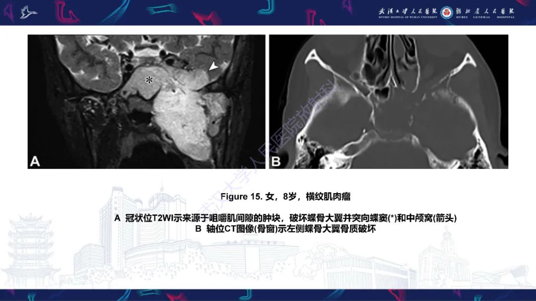 影像PPT - 【PPT】蝶骨大翼病变影像诊断-31