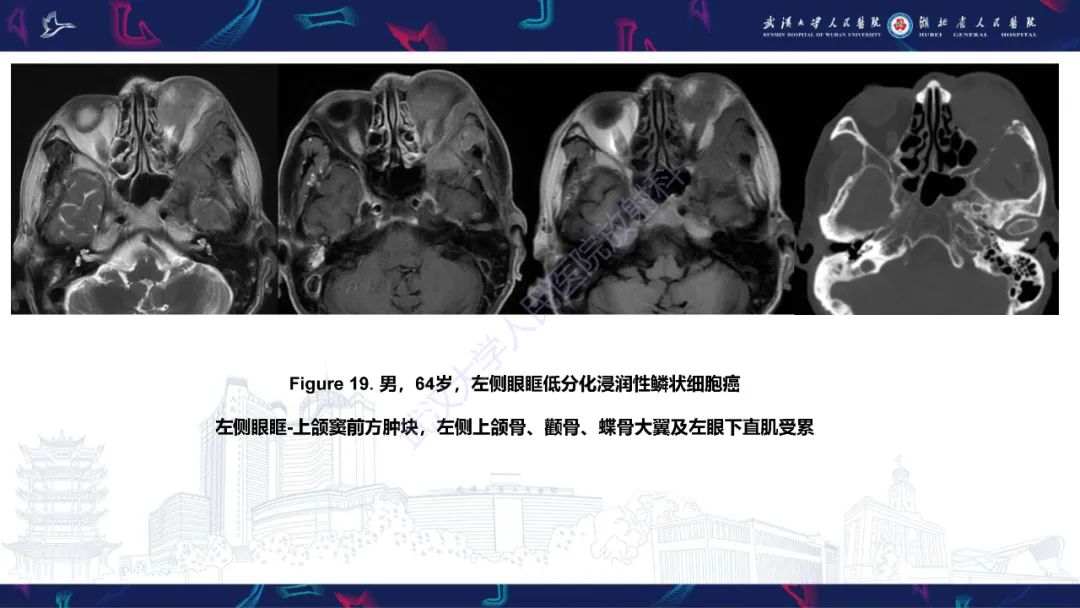 影像PPT - 【PPT】蝶骨大翼病变影像诊断-35