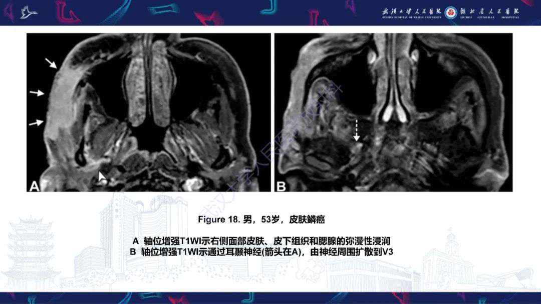 影像PPT - 【PPT】蝶骨大翼病变影像诊断-34