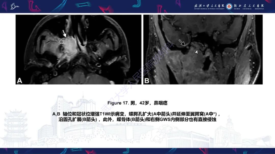 影像PPT - 【PPT】蝶骨大翼病变影像诊断-33