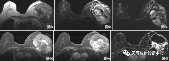 影像PPT - 【病例】粘液性乳腺癌1例MR影像-7 影像PPT - 【病例】粘液性乳腺癌1例MR影像-7