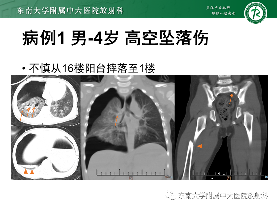 影像PPT - 【PPT】胸部外伤的影像学表现-5