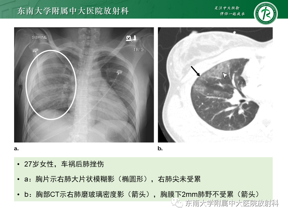 影像PPT - 【PPT】胸部外伤的影像学表现-11