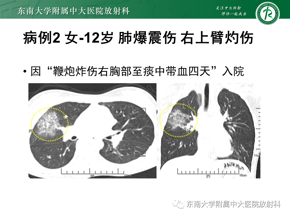 影像PPT - 【PPT】胸部外伤的影像学表现-6