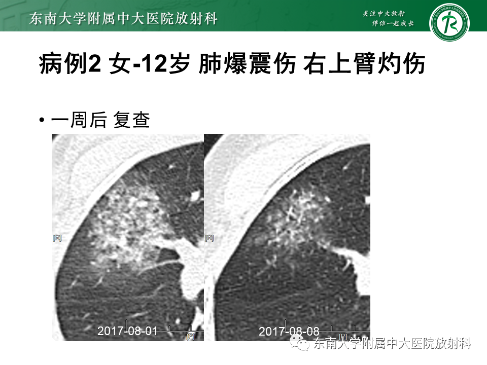 影像PPT - 【PPT】胸部外伤的影像学表现-13