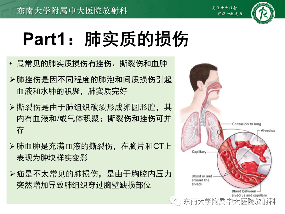 影像PPT - 【PPT】胸部外伤的影像学表现-9