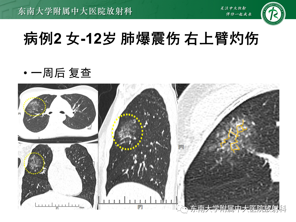 影像PPT - 【PPT】胸部外伤的影像学表现-12