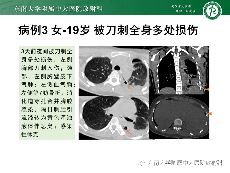 影像PPT - 【PPT】胸部外伤的影像学表现-17