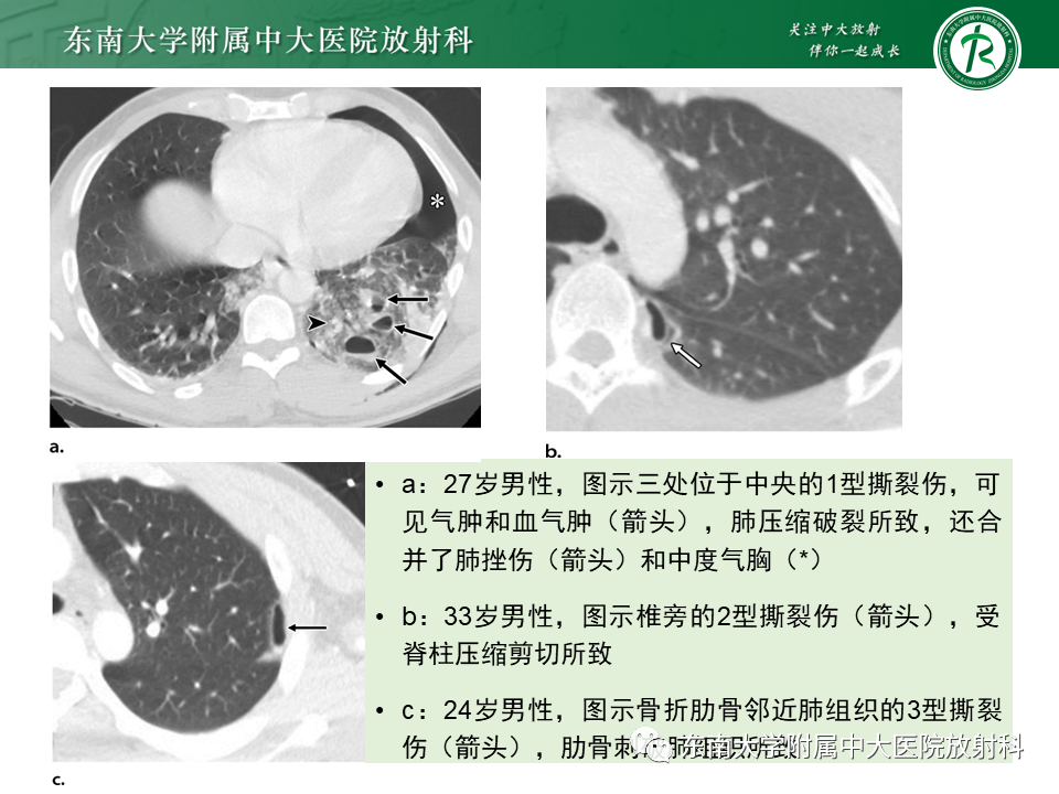 影像PPT - 【PPT】胸部外伤的影像学表现-19