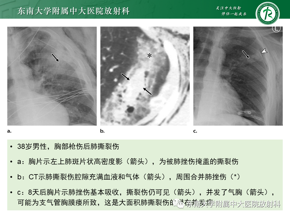 影像PPT - 【PPT】胸部外伤的影像学表现-16