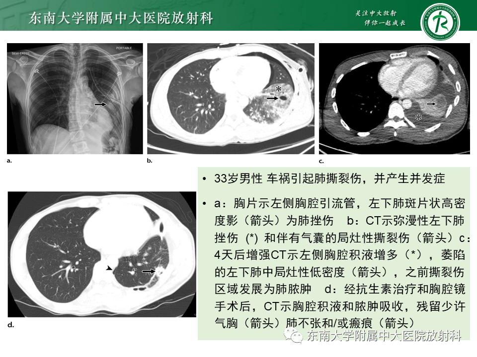 影像PPT - 【PPT】胸部外伤的影像学表现-21