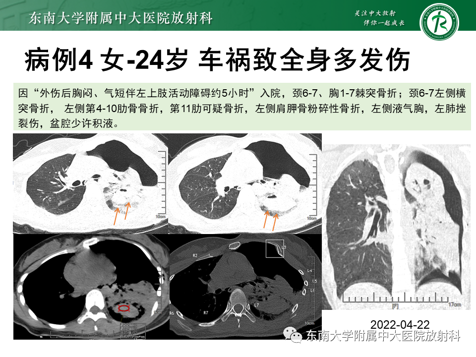 影像PPT - 【PPT】胸部外伤的影像学表现-22