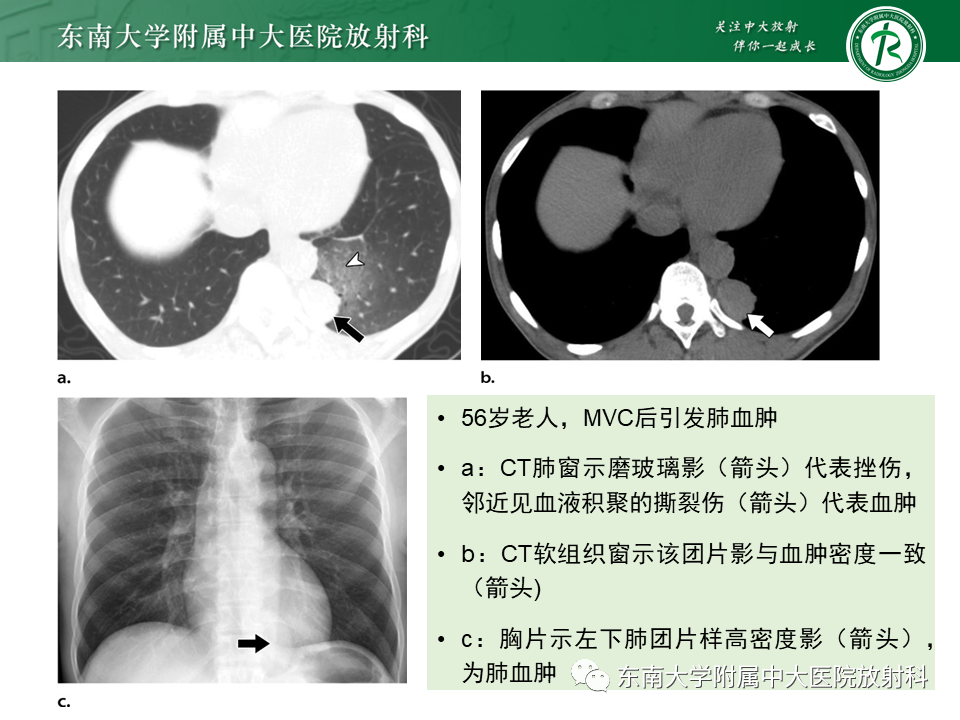 影像PPT - 【PPT】胸部外伤的影像学表现-24