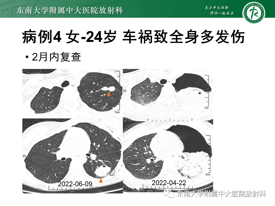 影像PPT - 【PPT】胸部外伤的影像学表现-25