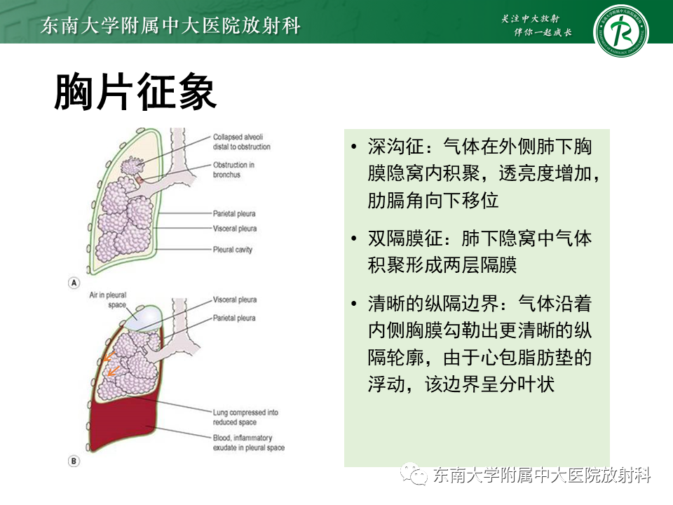 影像PPT - 【PPT】胸部外伤的影像学表现-28