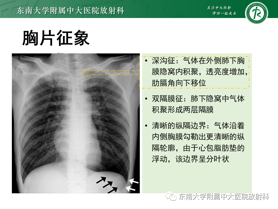 影像PPT - 【PPT】胸部外伤的影像学表现-29