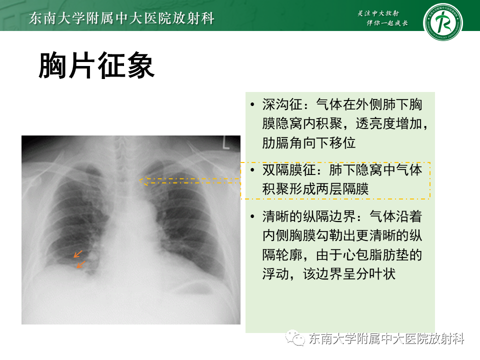 影像PPT - 【PPT】胸部外伤的影像学表现-30