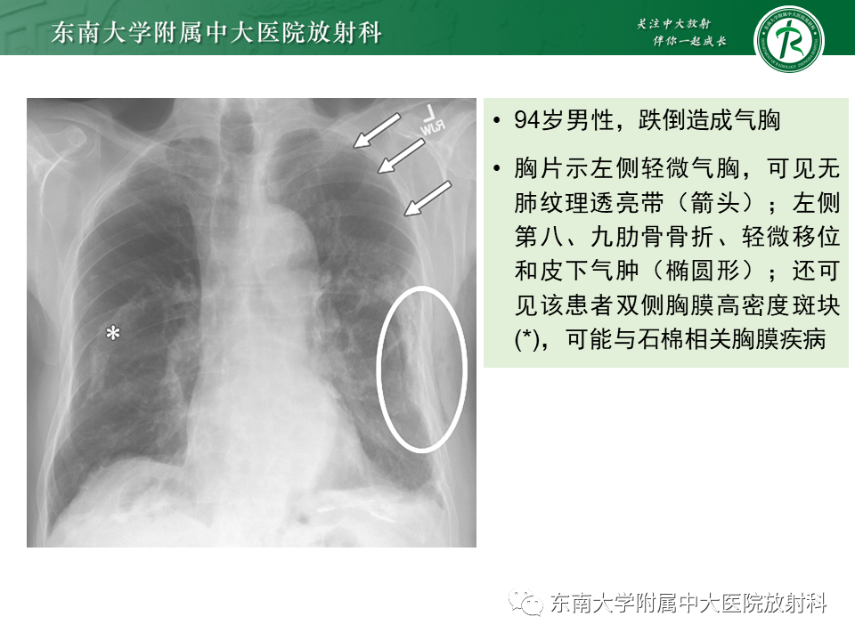 影像PPT - 【PPT】胸部外伤的影像学表现-27