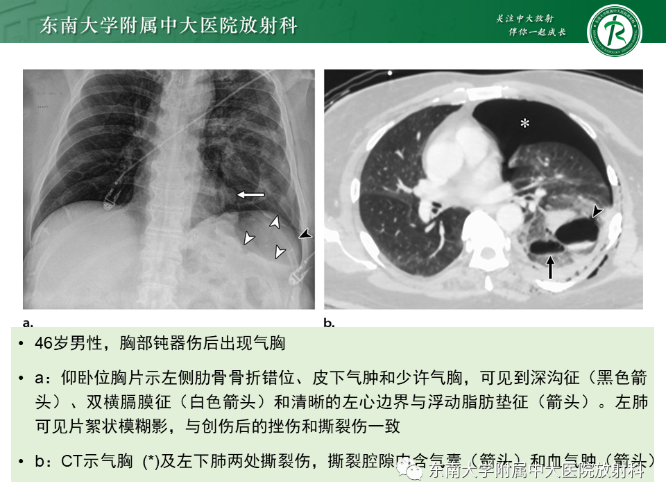 影像PPT - 【PPT】胸部外伤的影像学表现-32