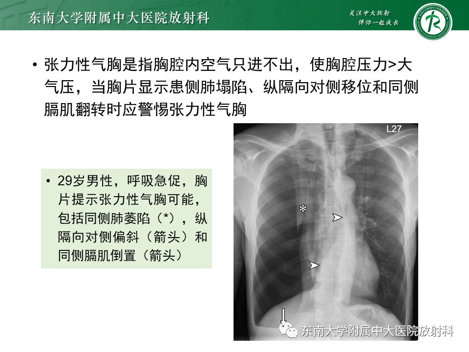 影像PPT - 【PPT】胸部外伤的影像学表现-33