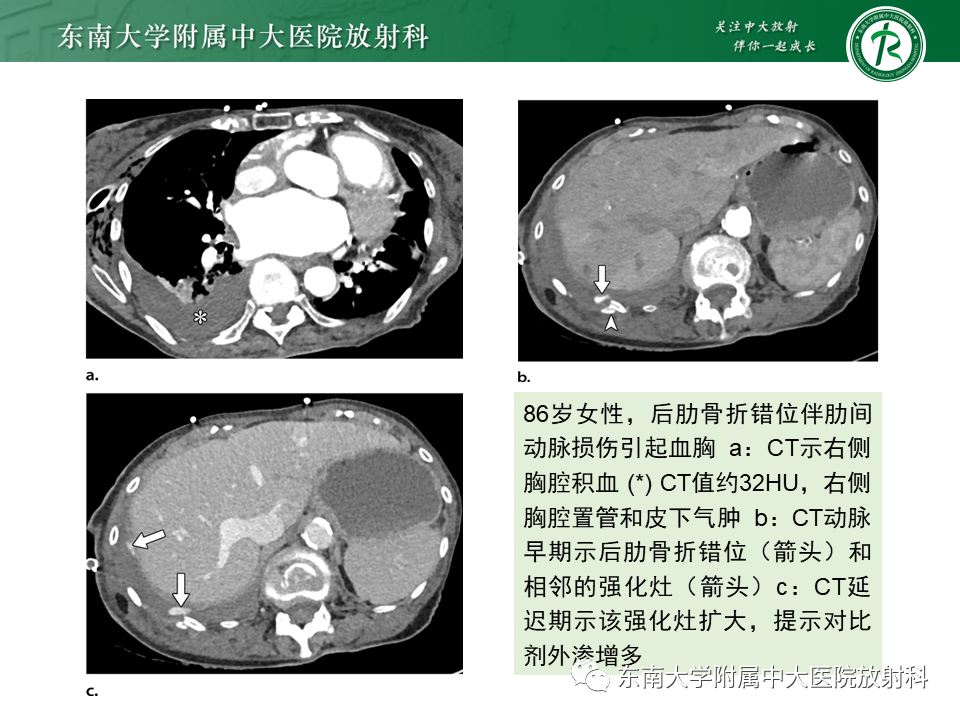影像PPT - 【PPT】胸部外伤的影像学表现-36