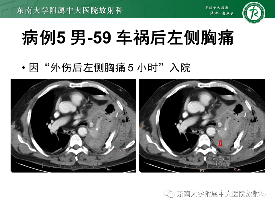 影像PPT - 【PPT】胸部外伤的影像学表现-38