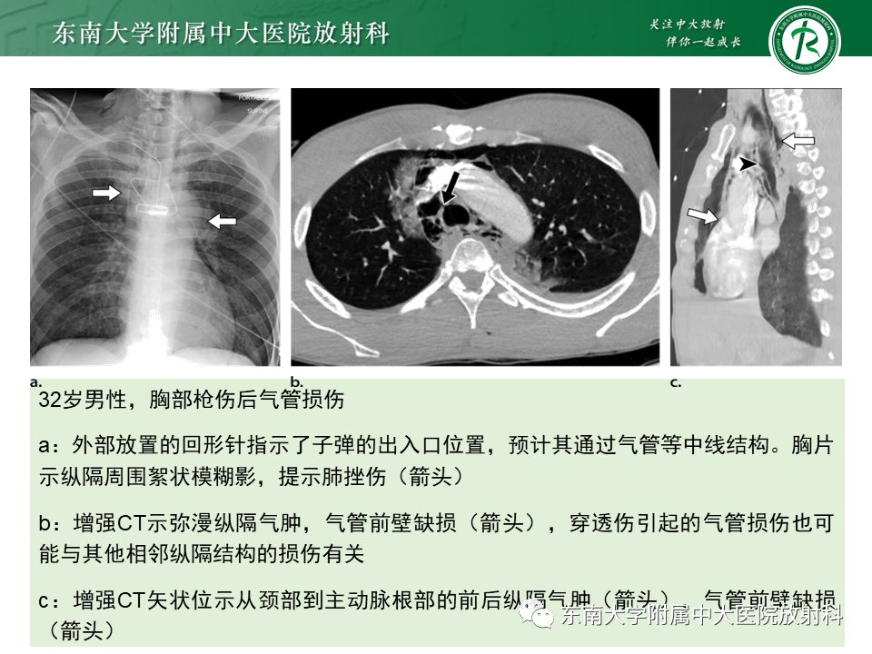 影像PPT - 【PPT】胸部外伤的影像学表现-41