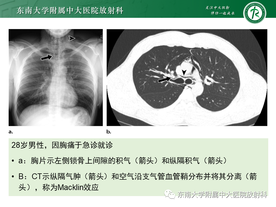 影像PPT - 【PPT】胸部外伤的影像学表现-42
