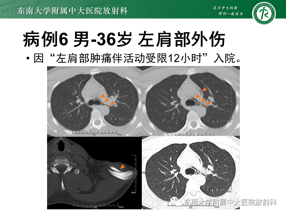 影像PPT - 【PPT】胸部外伤的影像学表现-44