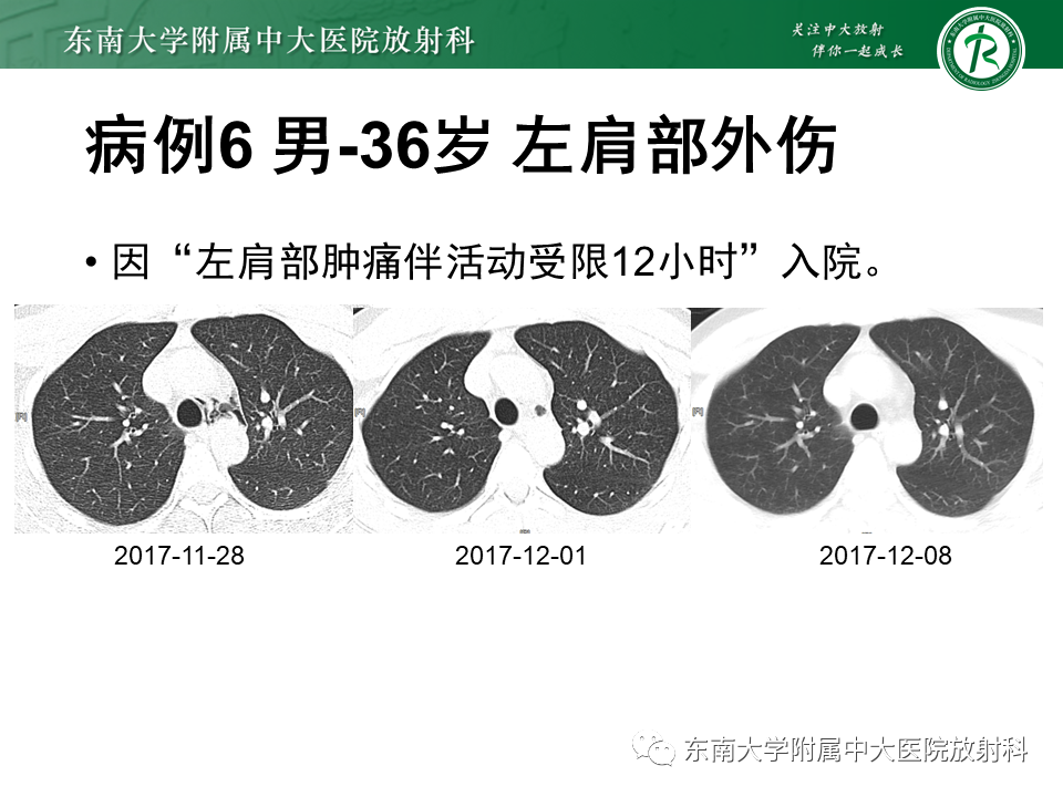 影像PPT - 【PPT】胸部外伤的影像学表现-45