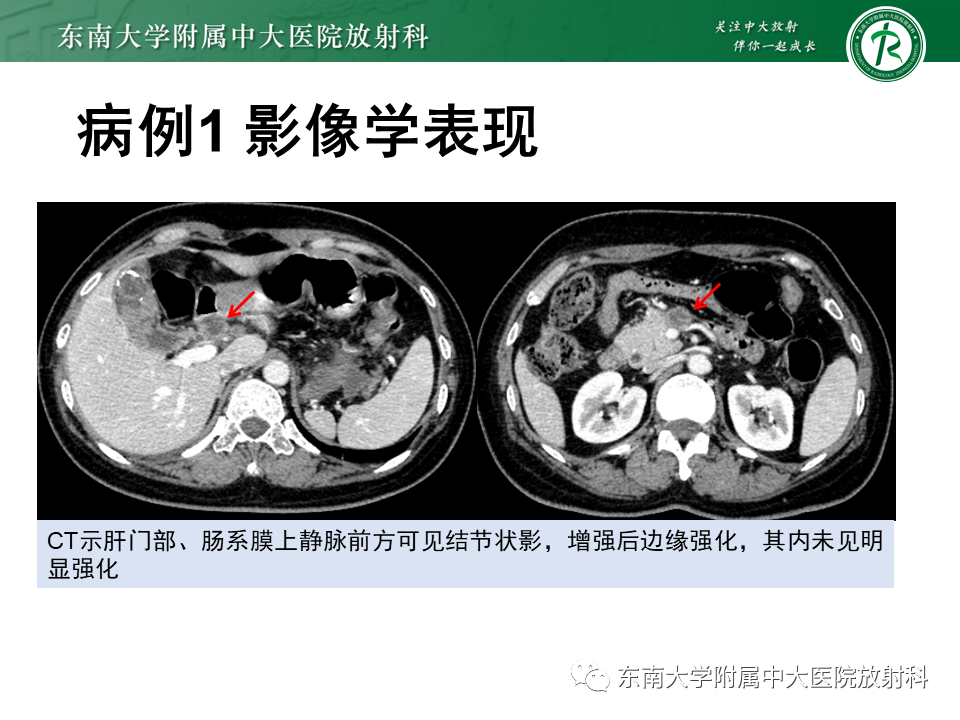 影像PPT - 【PPT】胆囊癌-5 影像PPT - 【PPT】胆囊癌-5