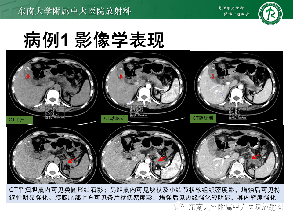 影像PPT - 【PPT】胆囊癌-4 影像PPT - 【PPT】胆囊癌-4