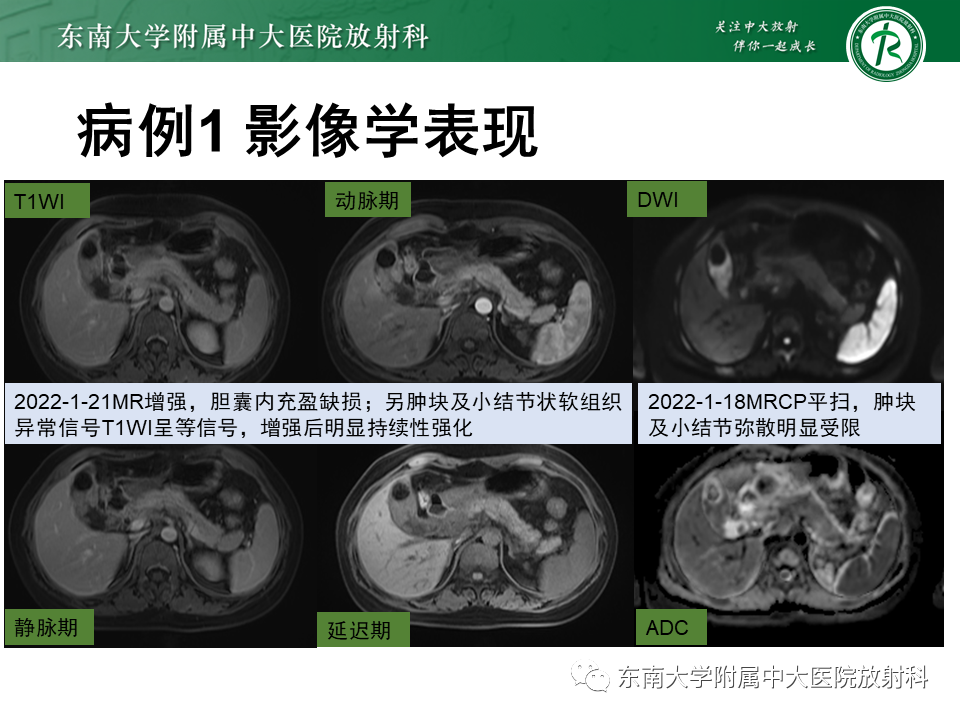 影像PPT - 【PPT】胆囊癌-6 影像PPT - 【PPT】胆囊癌-6