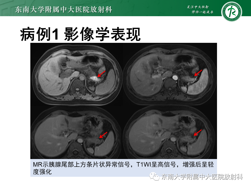 影像PPT - 【PPT】胆囊癌-7 影像PPT - 【PPT】胆囊癌-7