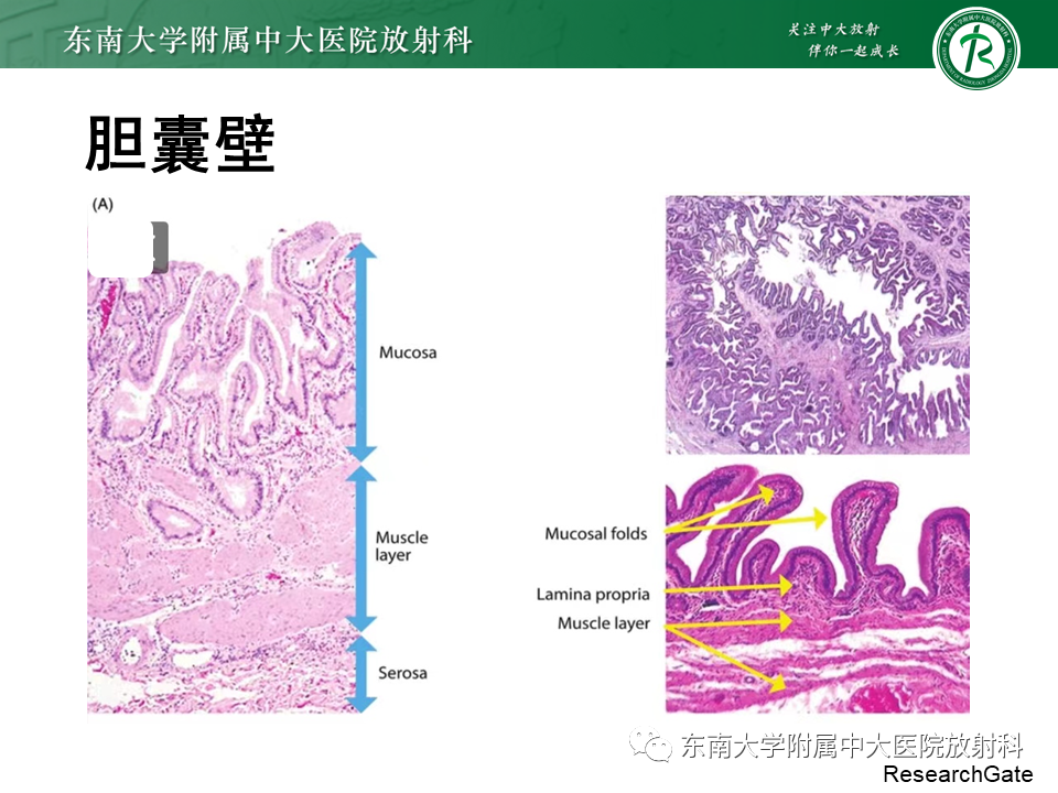 影像PPT - 【PPT】胆囊癌-14 影像PPT - 【PPT】胆囊癌-14