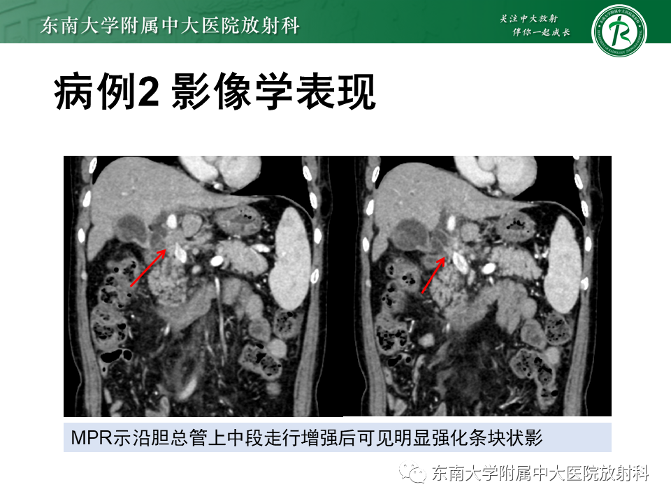 影像PPT - 【PPT】胆囊癌-22 影像PPT - 【PPT】胆囊癌-22