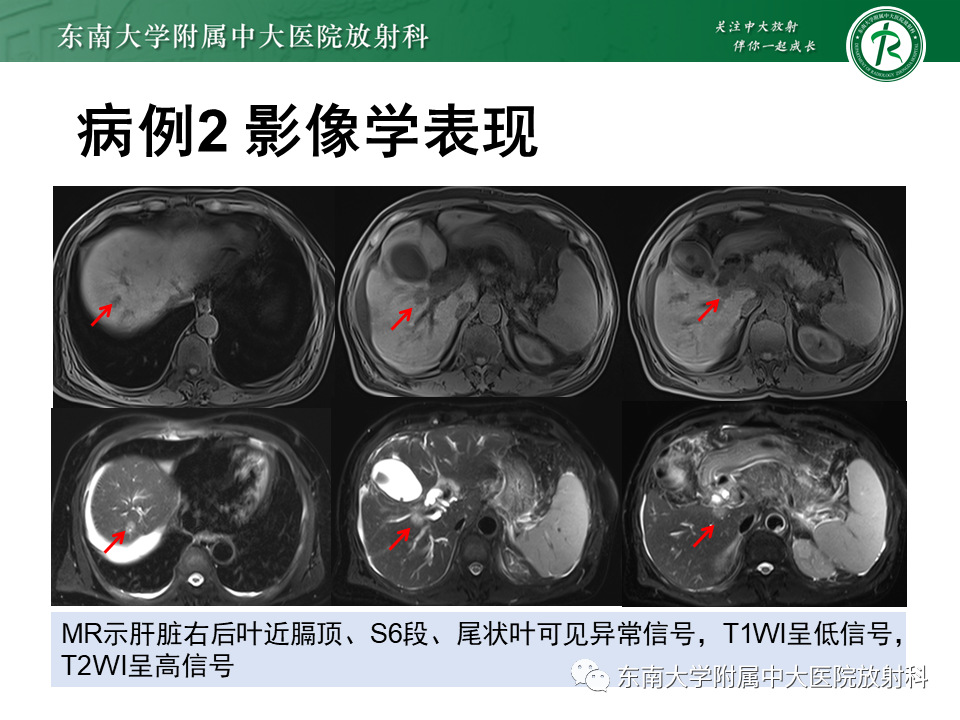 影像PPT - 【PPT】胆囊癌-23 影像PPT - 【PPT】胆囊癌-23