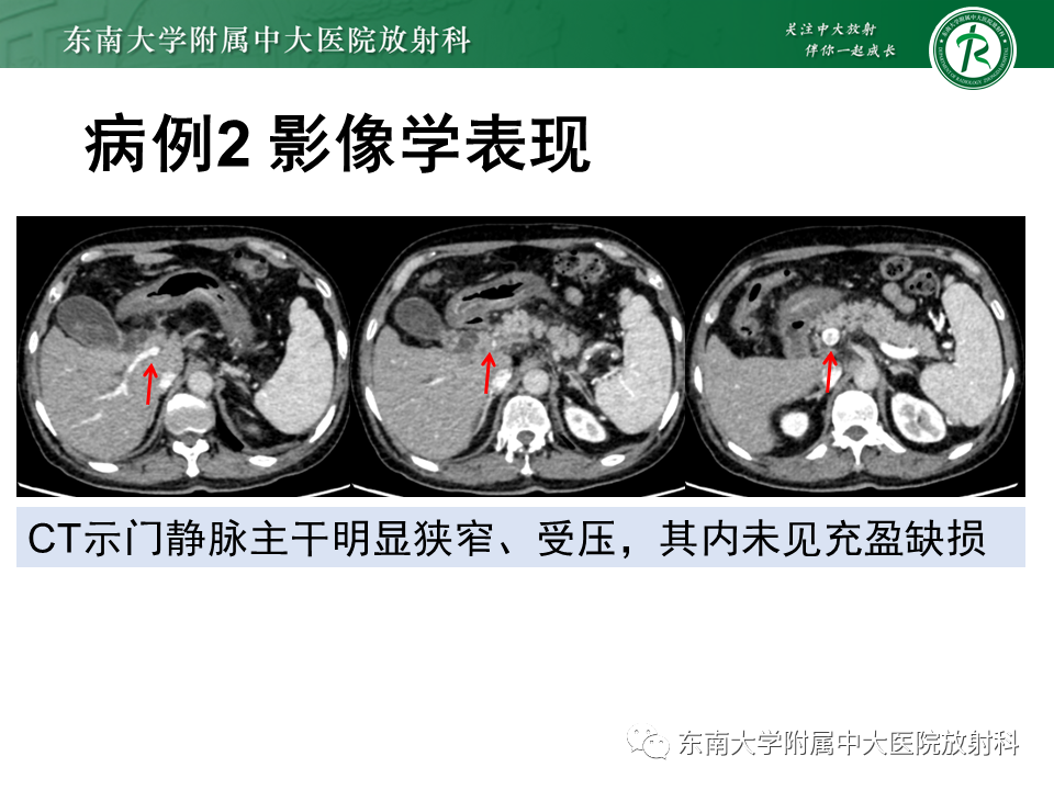 影像PPT - 【PPT】胆囊癌-21 影像PPT - 【PPT】胆囊癌-21
