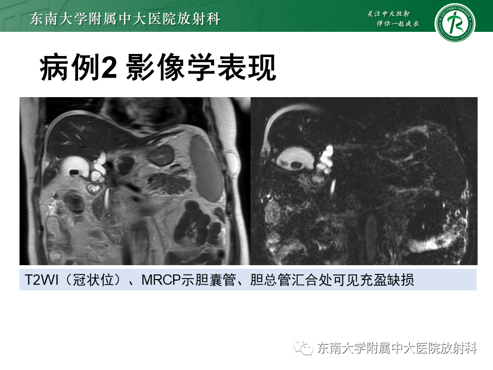 影像PPT - 【PPT】胆囊癌-24 影像PPT - 【PPT】胆囊癌-24