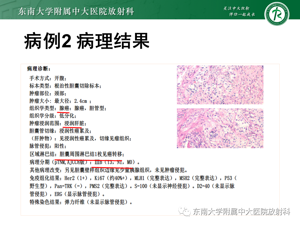影像PPT - 【PPT】胆囊癌-27 影像PPT - 【PPT】胆囊癌-27