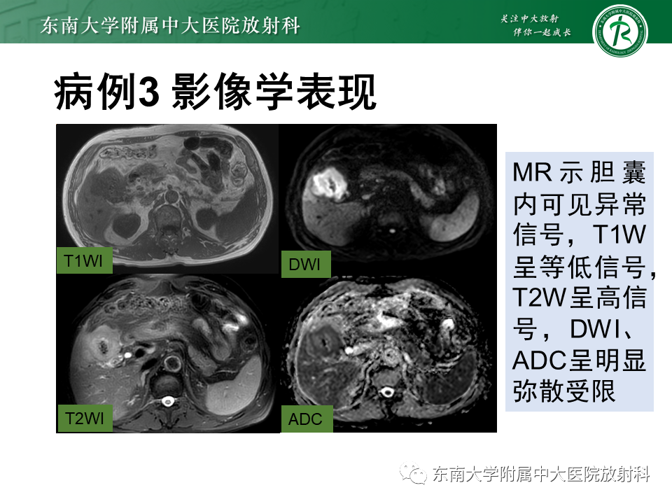 影像PPT - 【PPT】胆囊癌-30 影像PPT - 【PPT】胆囊癌-30