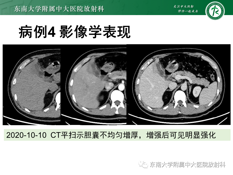 影像PPT - 【PPT】胆囊癌-40 影像PPT - 【PPT】胆囊癌-40