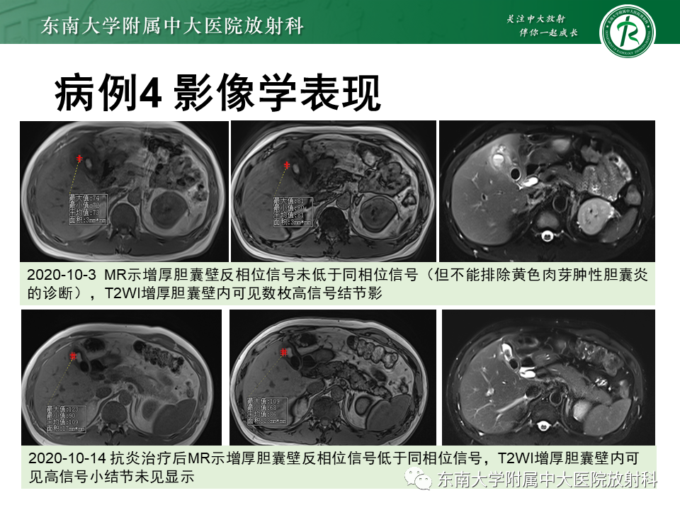 影像PPT - 【PPT】胆囊癌-41 影像PPT - 【PPT】胆囊癌-41