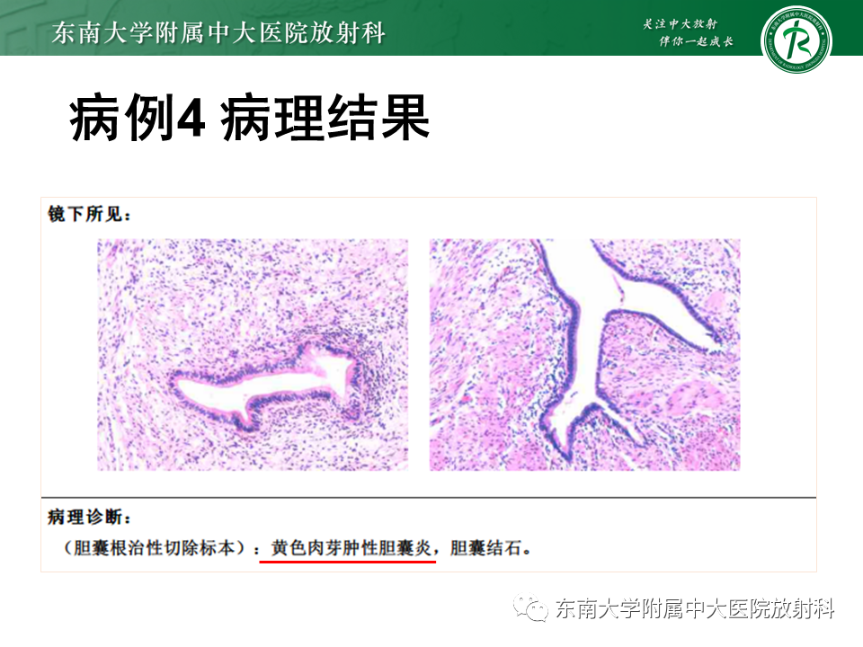 影像PPT - 【PPT】胆囊癌-42 影像PPT - 【PPT】胆囊癌-42