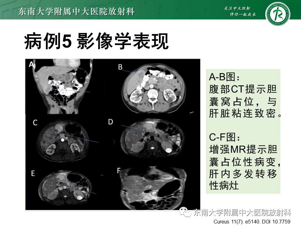 影像PPT - 【PPT】胆囊癌-46 影像PPT - 【PPT】胆囊癌-46