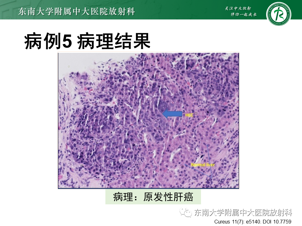 影像PPT - 【PPT】胆囊癌-47 影像PPT - 【PPT】胆囊癌-47